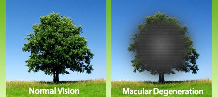 Macular-Degeneration